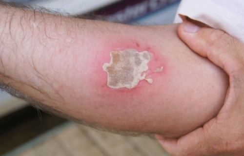 Hand Injury attorney | spiro k pistiolas