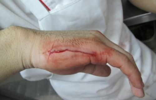 Hand Injury attorney | spiro k pistiolas